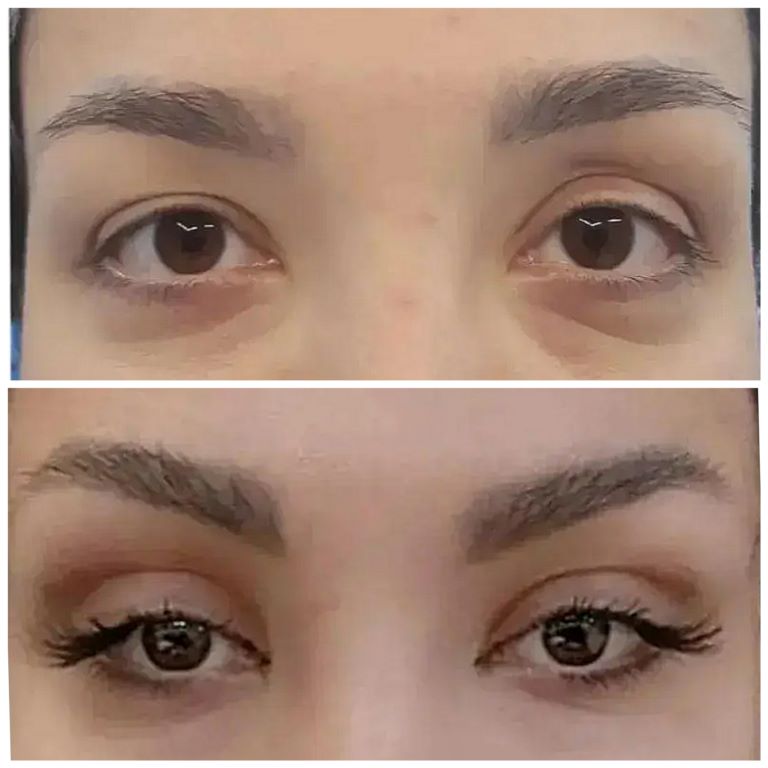 جراحی زیبایی پلک