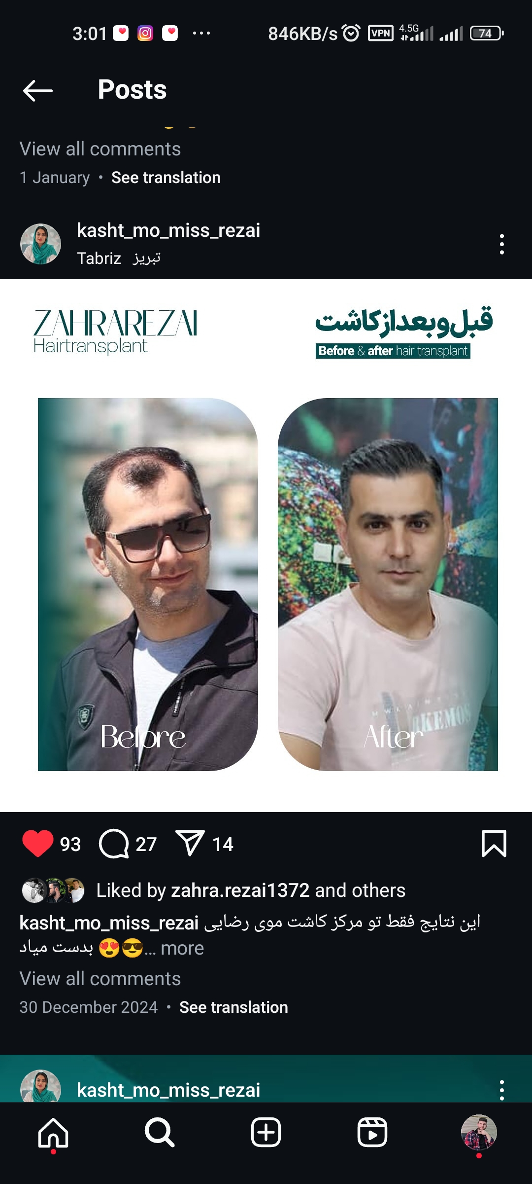 کاشت مو و کاشت ابرو