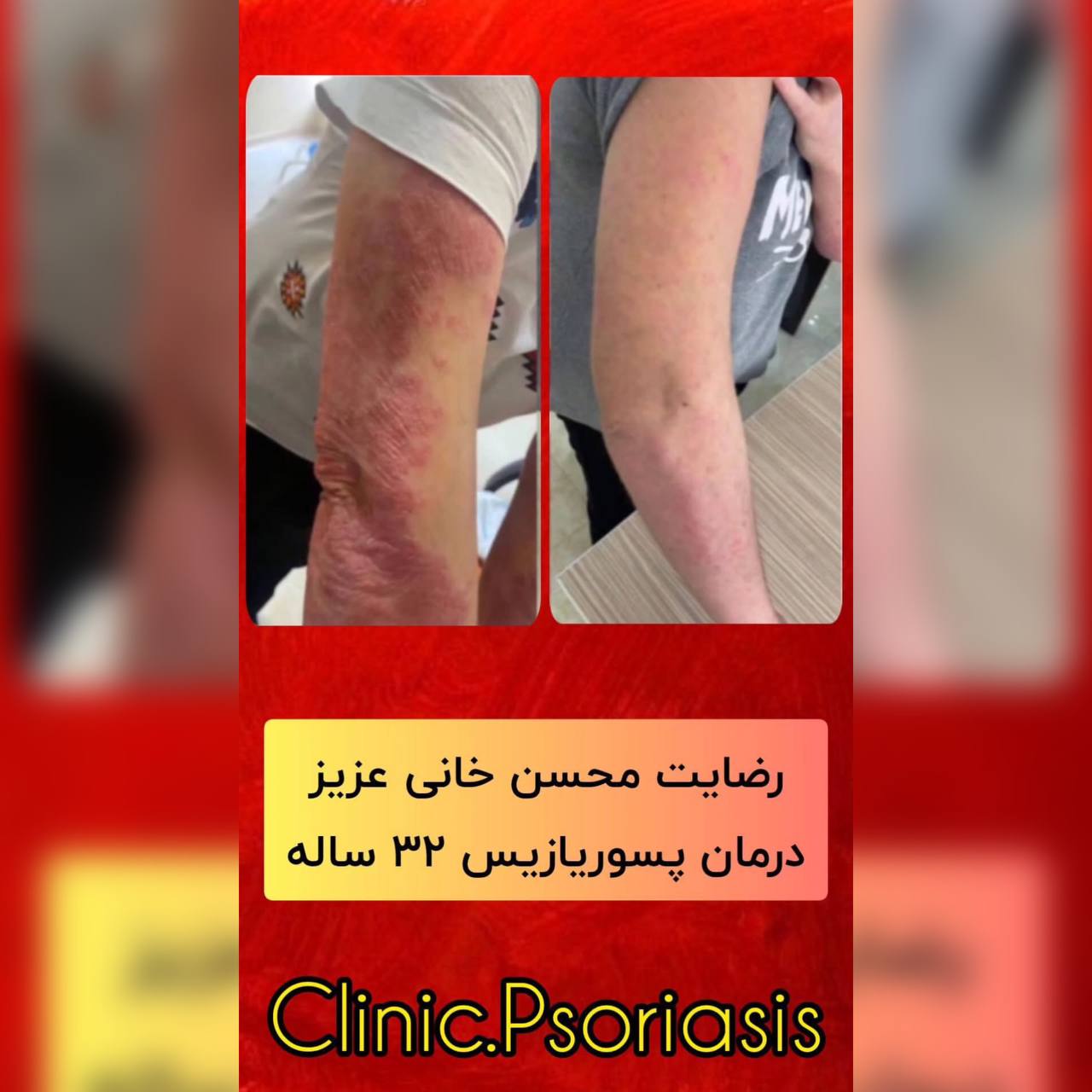 درمان پیسی و پسوریازیس