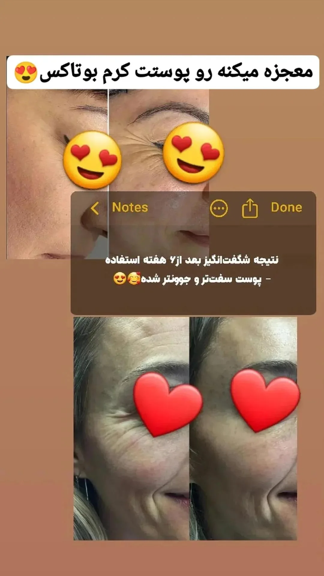 کرم بوتاکس طبعیی