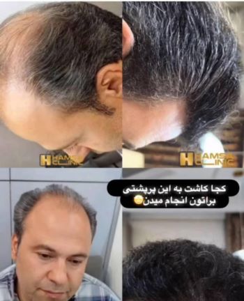 کاشت مو تضمیمی 