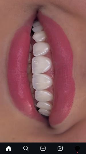 کامپوزیت زیبایی دندان