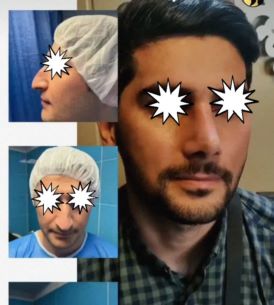 عمل زیبایی بینی