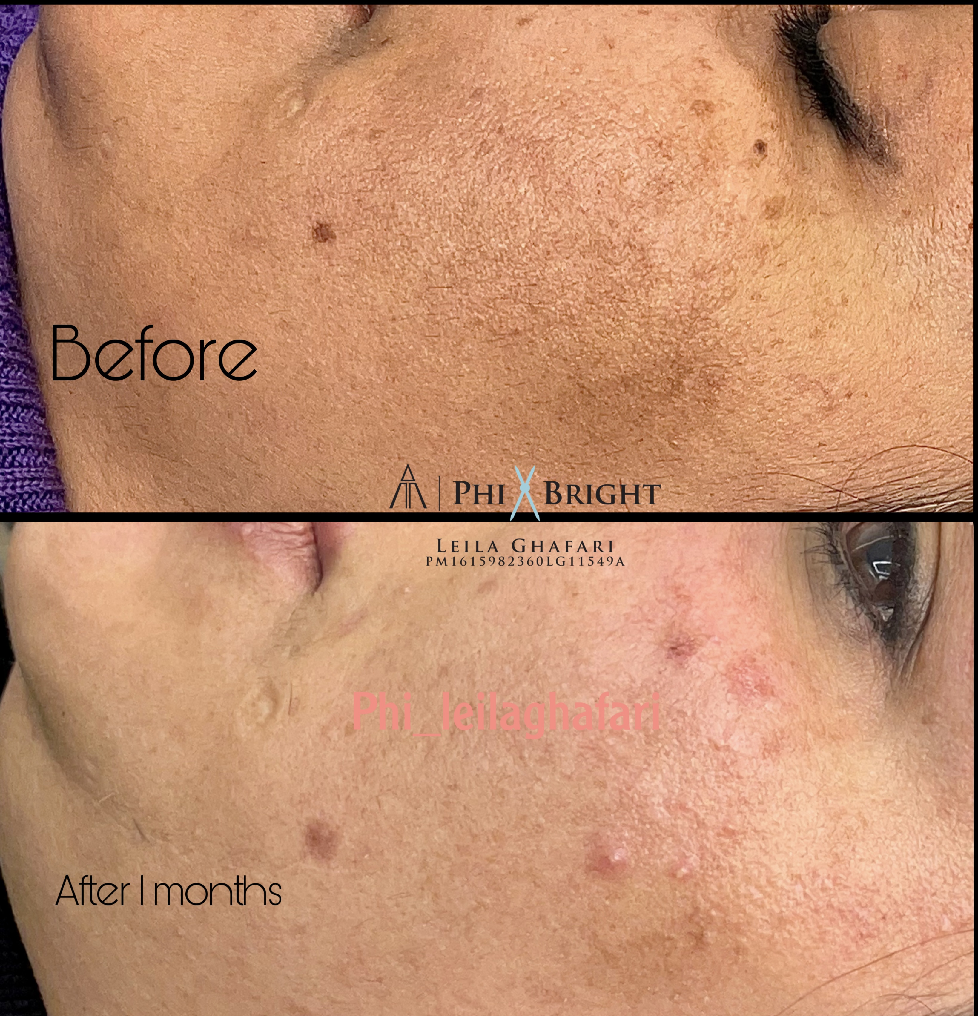 درمان قطعی انواع لک و تیرگی 