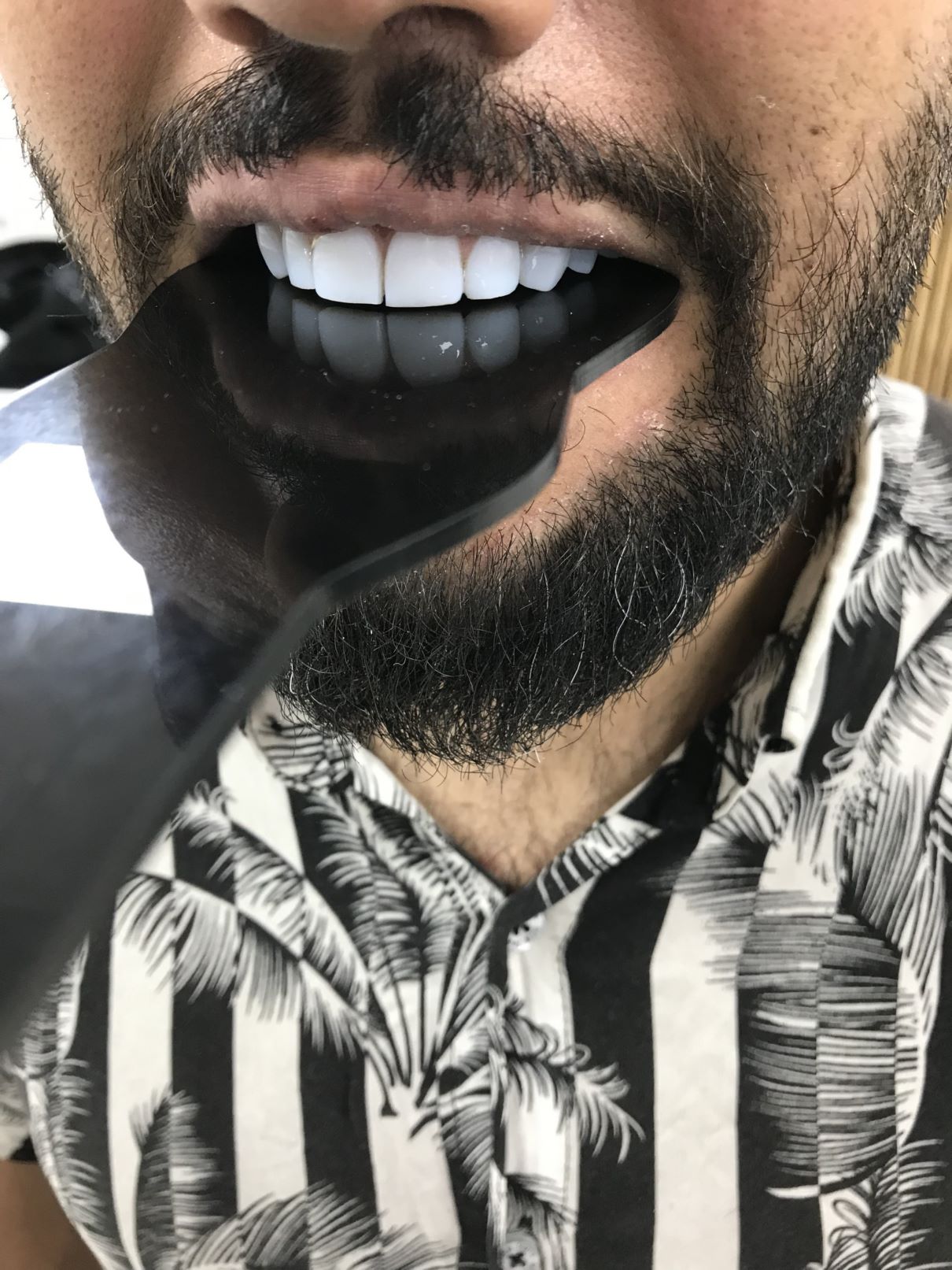 کامپوزیت زیبایی دندان