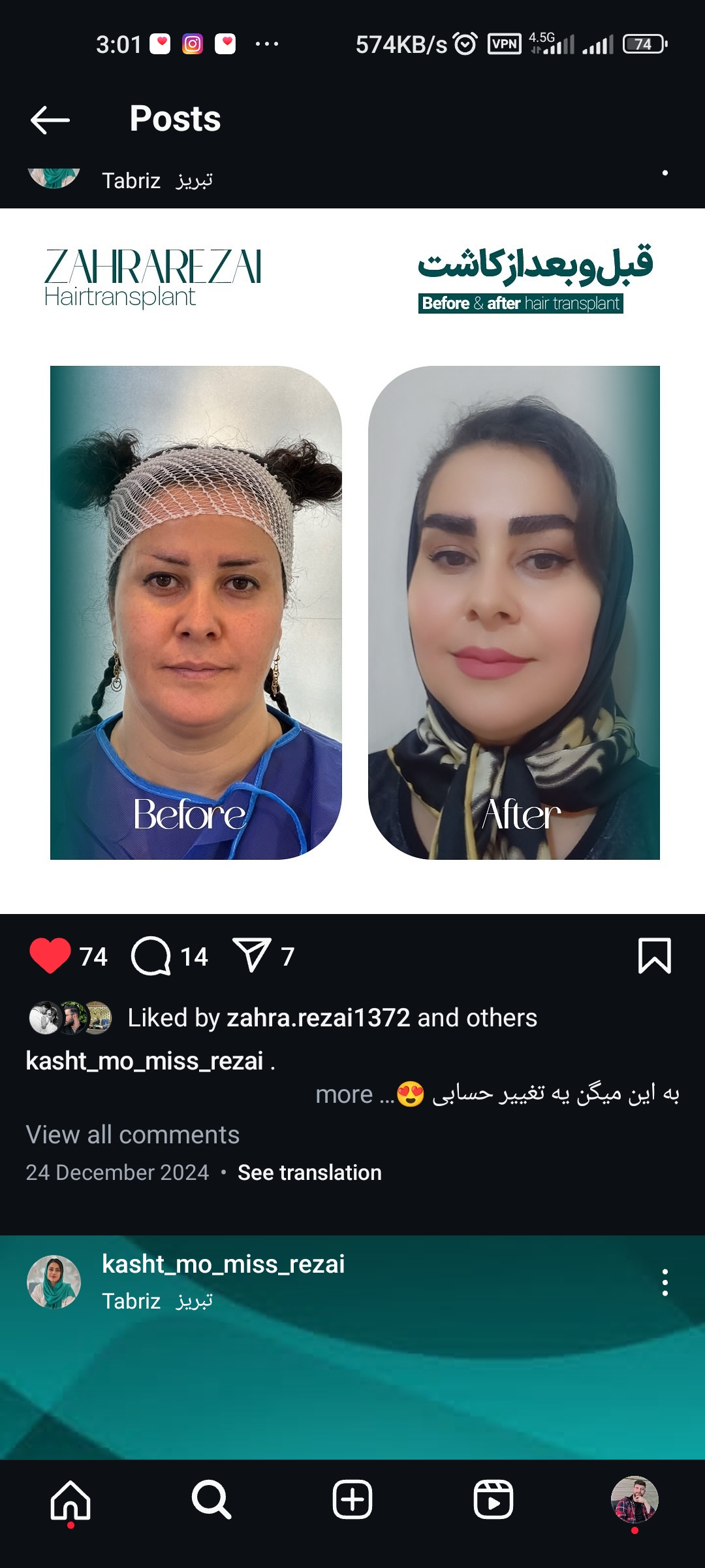 کاشت مو و کاشت ابرو