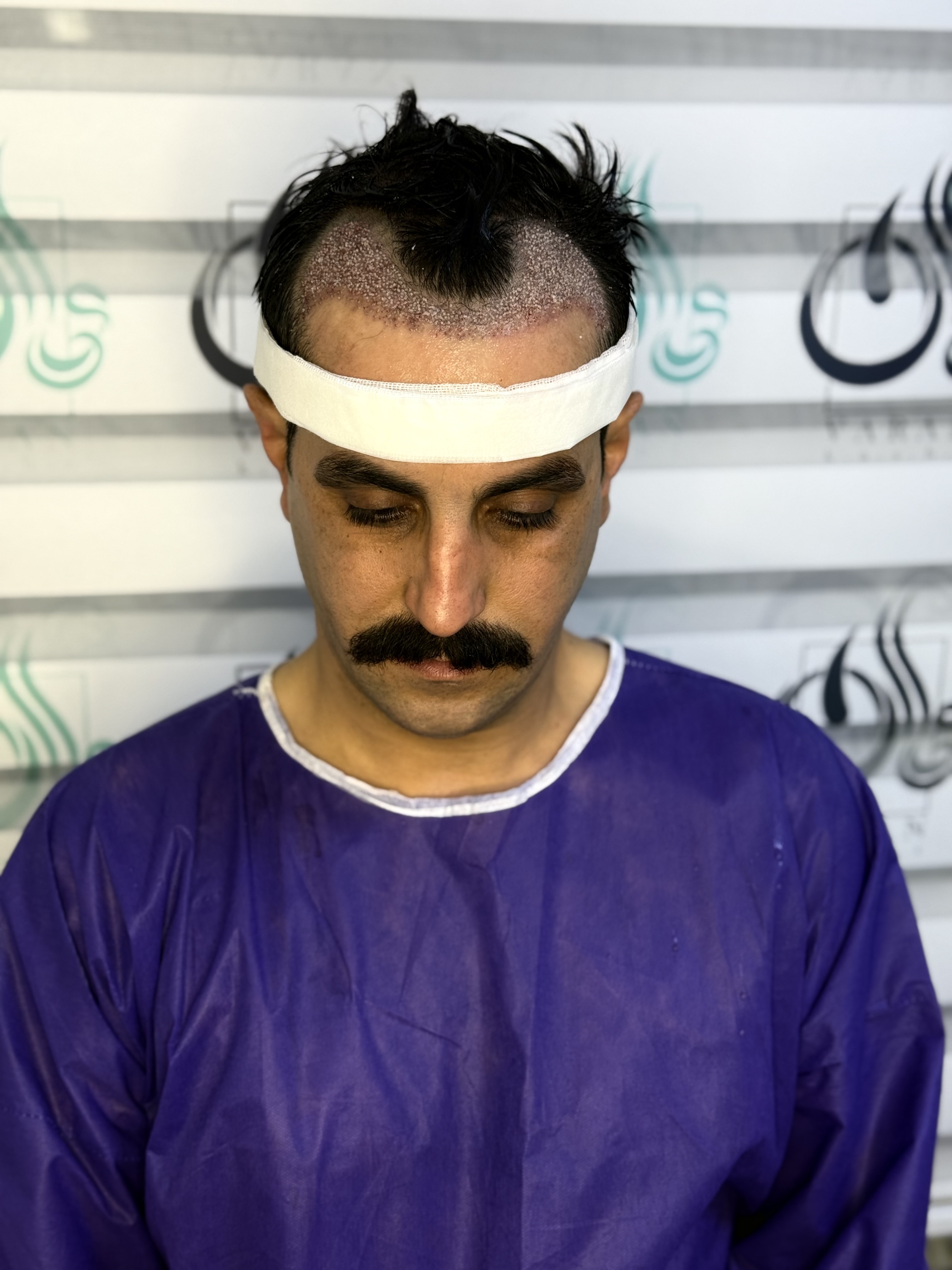 کاشت مو طبیعی 