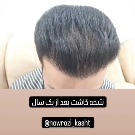 کاشت مو و ابرو و ریش