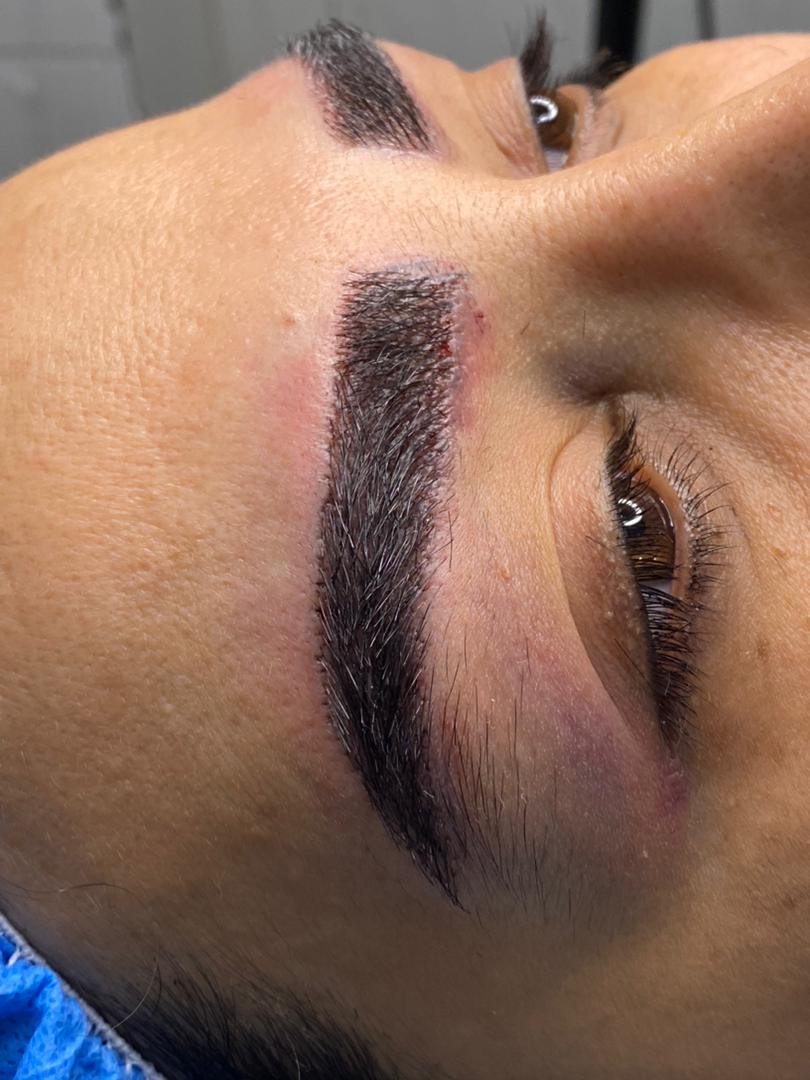 کاشت مو و ابرو توسط کادر درمان