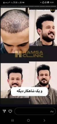 کاشت مو تضمیمی 