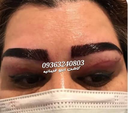 کاشت مو و ابرو بصورت تخصصی