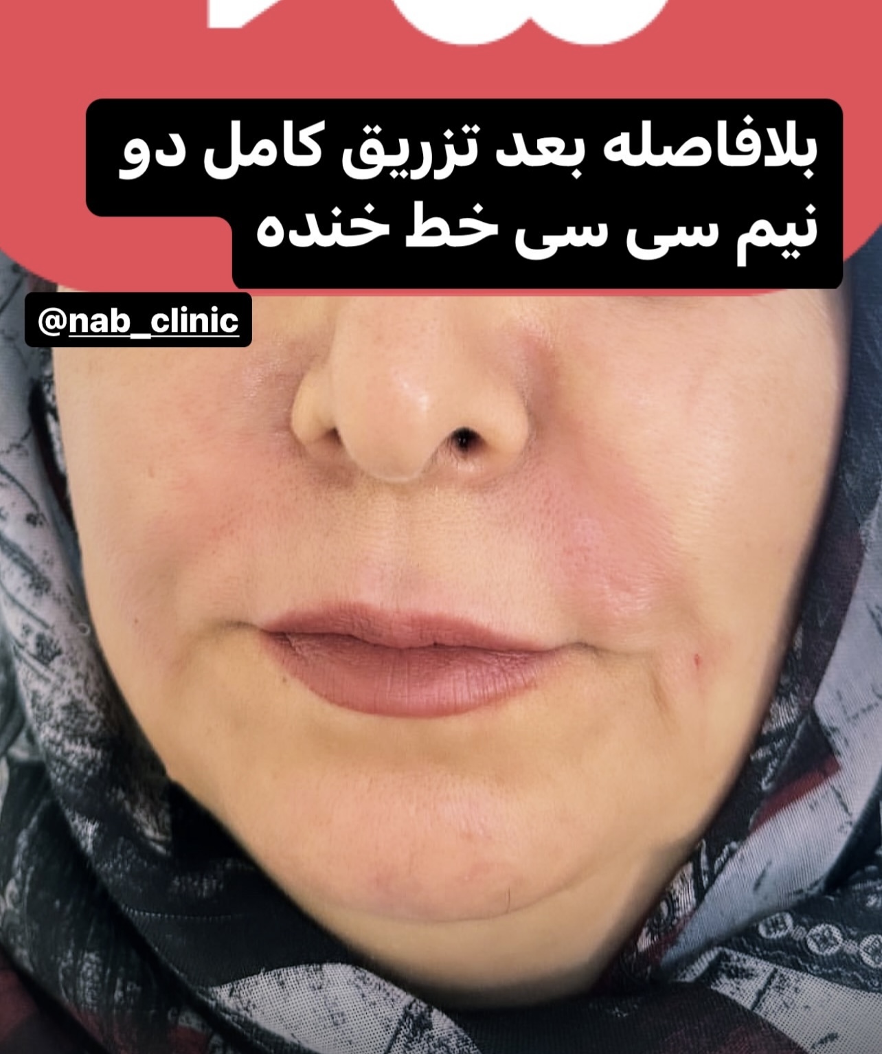  تزریق تمای کارهای زیبایی صورت و بدن