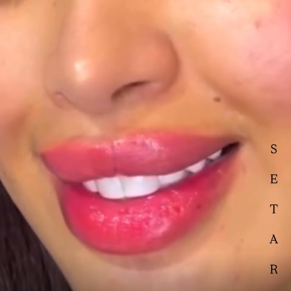 تخفيف ويژه تزريق فيلر و بوتاكس