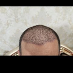 کاشت مو و ابرو 