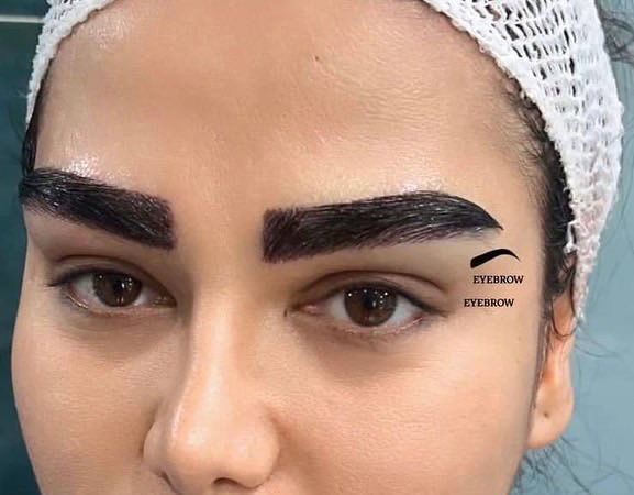 کاشت ابرو طبیعی پرتراکم