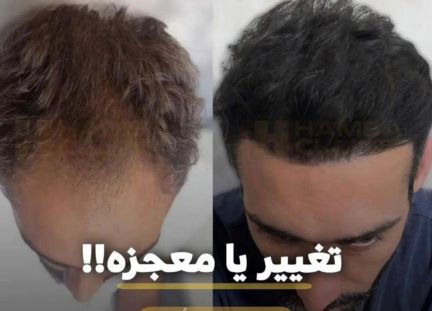 کاشت مو تضمیمی 