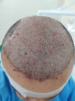 کاشت مو و ابرو در شیراز