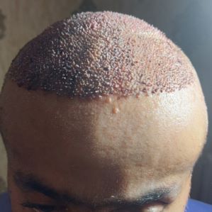 کاشت مو حرفه ای 