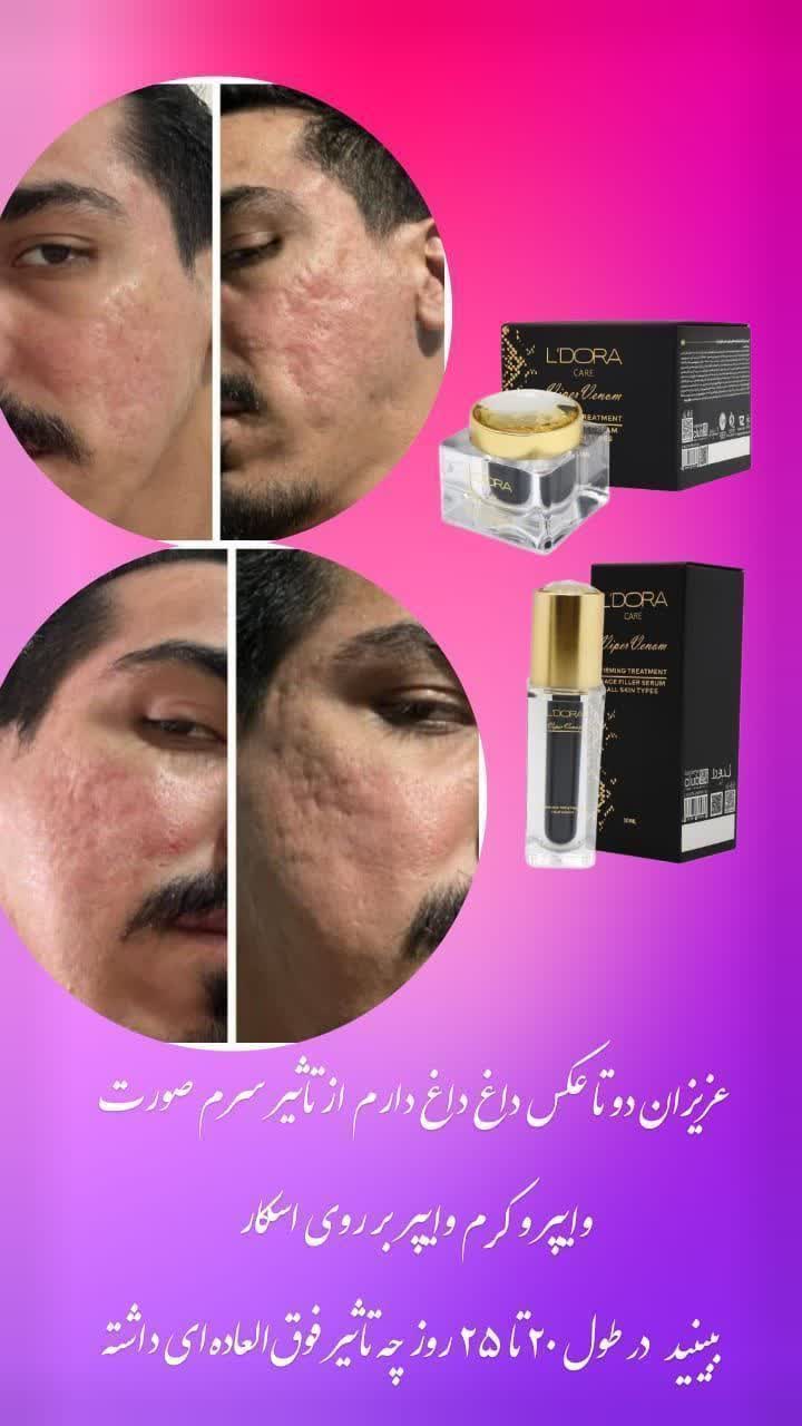 جایگزین مناسب بوتاکس