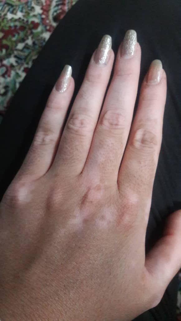 درمان پیسی و ویتیلیگو و برص