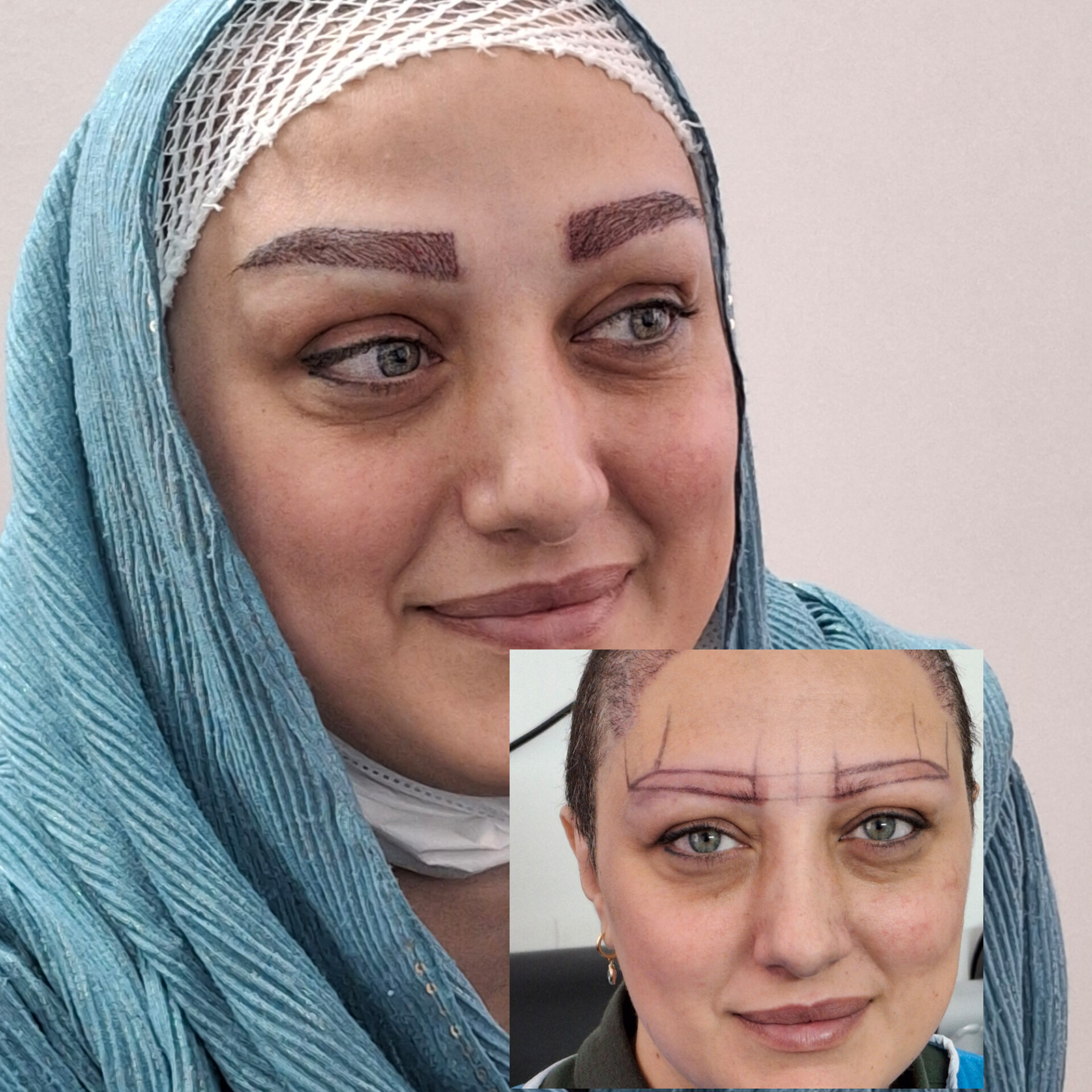  پیوندکاشت ابرو