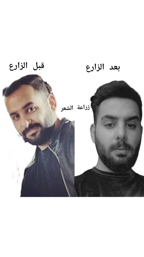 کاشت مو و ابرو در شیراز