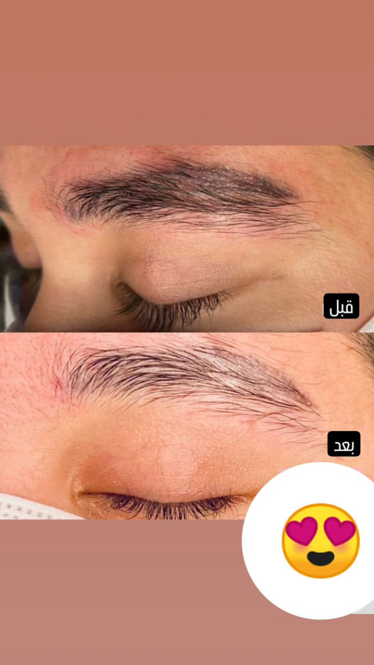 ریموو تتو در یک جلسه