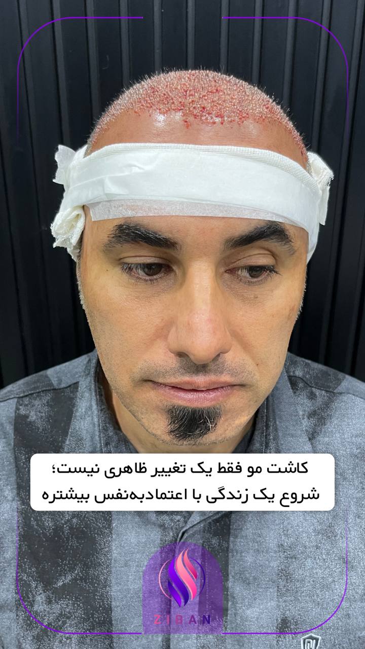 کاشت مو و کاشت ابرو 