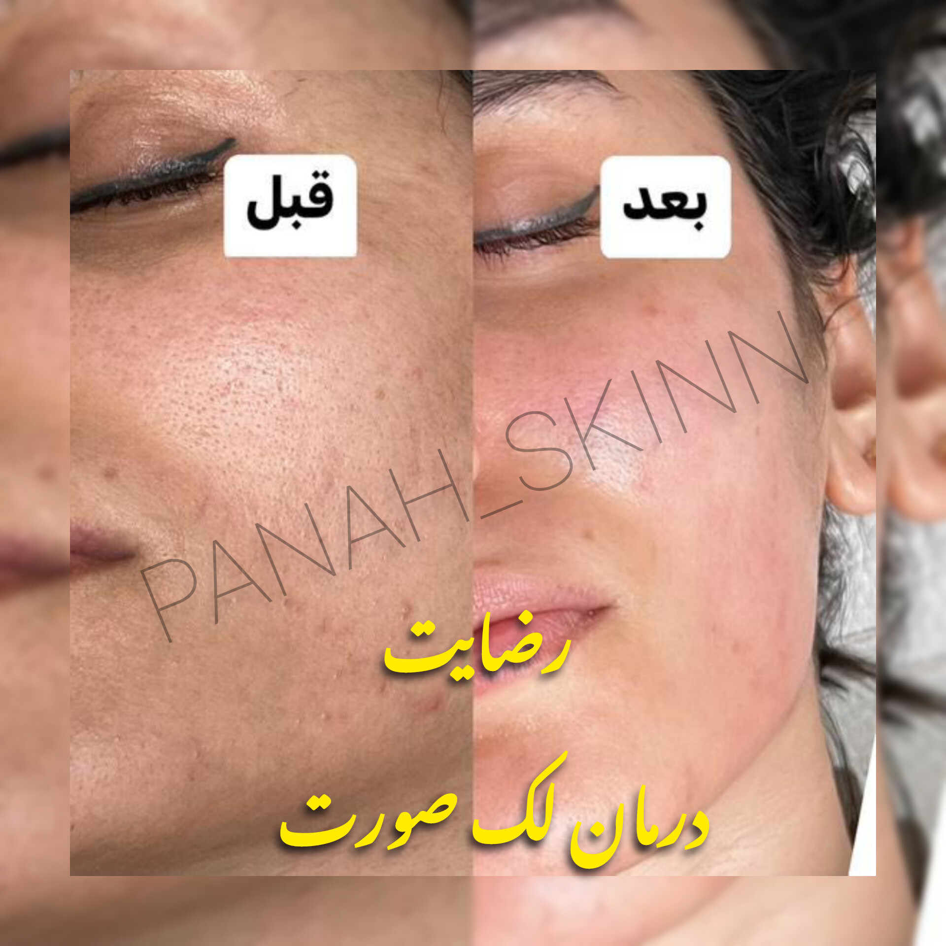 سرم ضدلک لاکچرکوین فرانسه 
