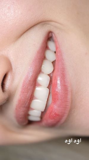 کامپوزیت زیبایی دندان