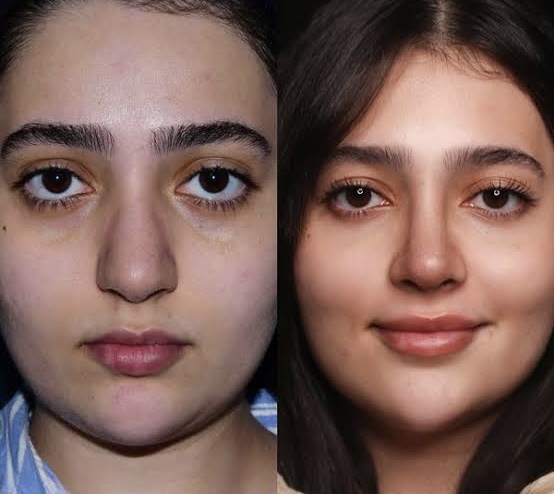 جراحی بینی و پلک