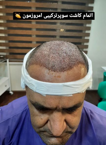 آموزش کاشت مو و ابرو تضمینی