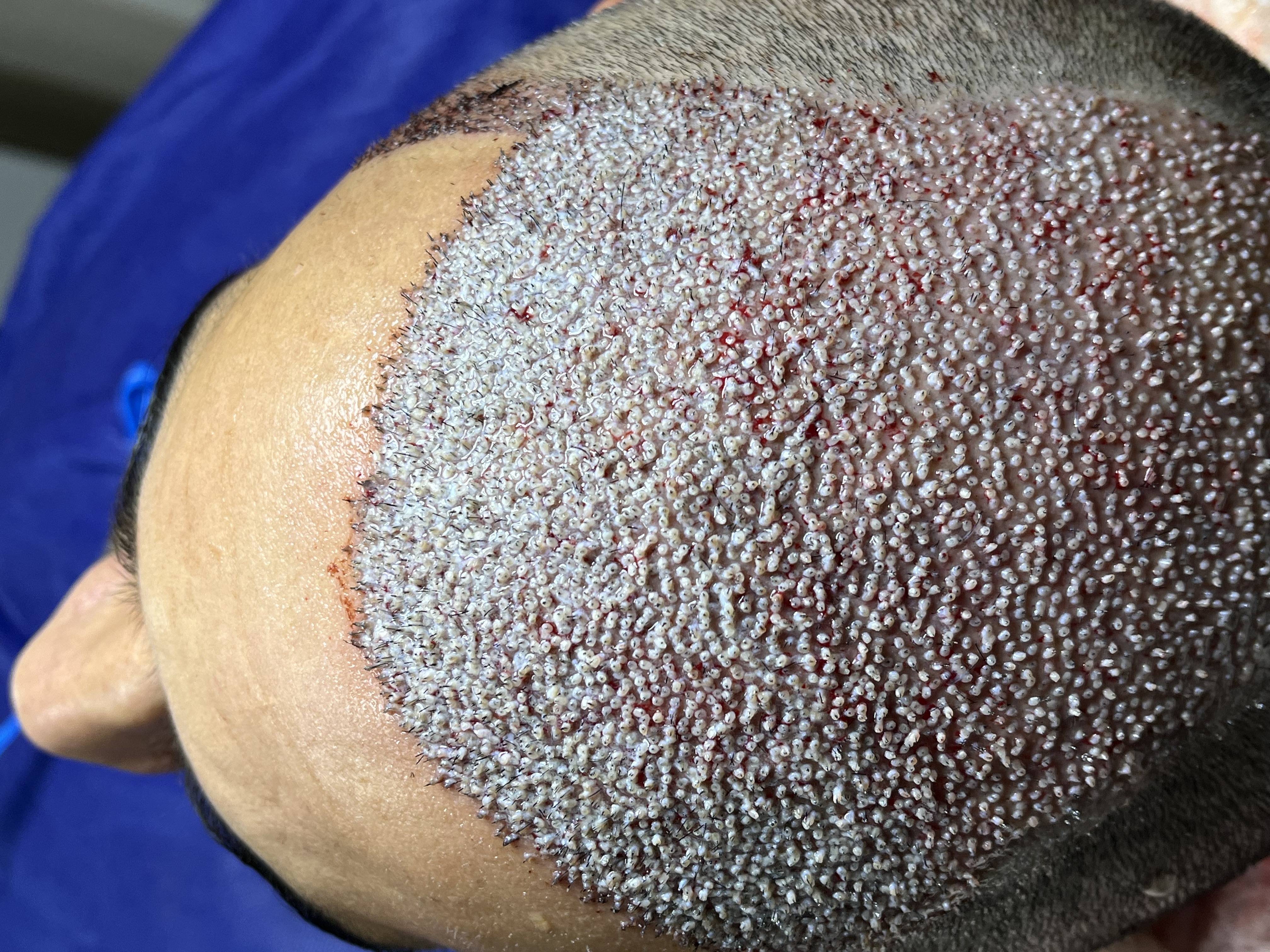 کاشت مو و ابرو توسط کادر درمان