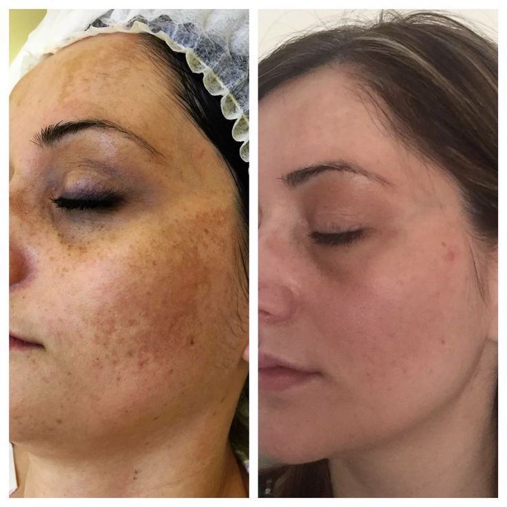 درمان قطعی انواع لک و تیرگی 