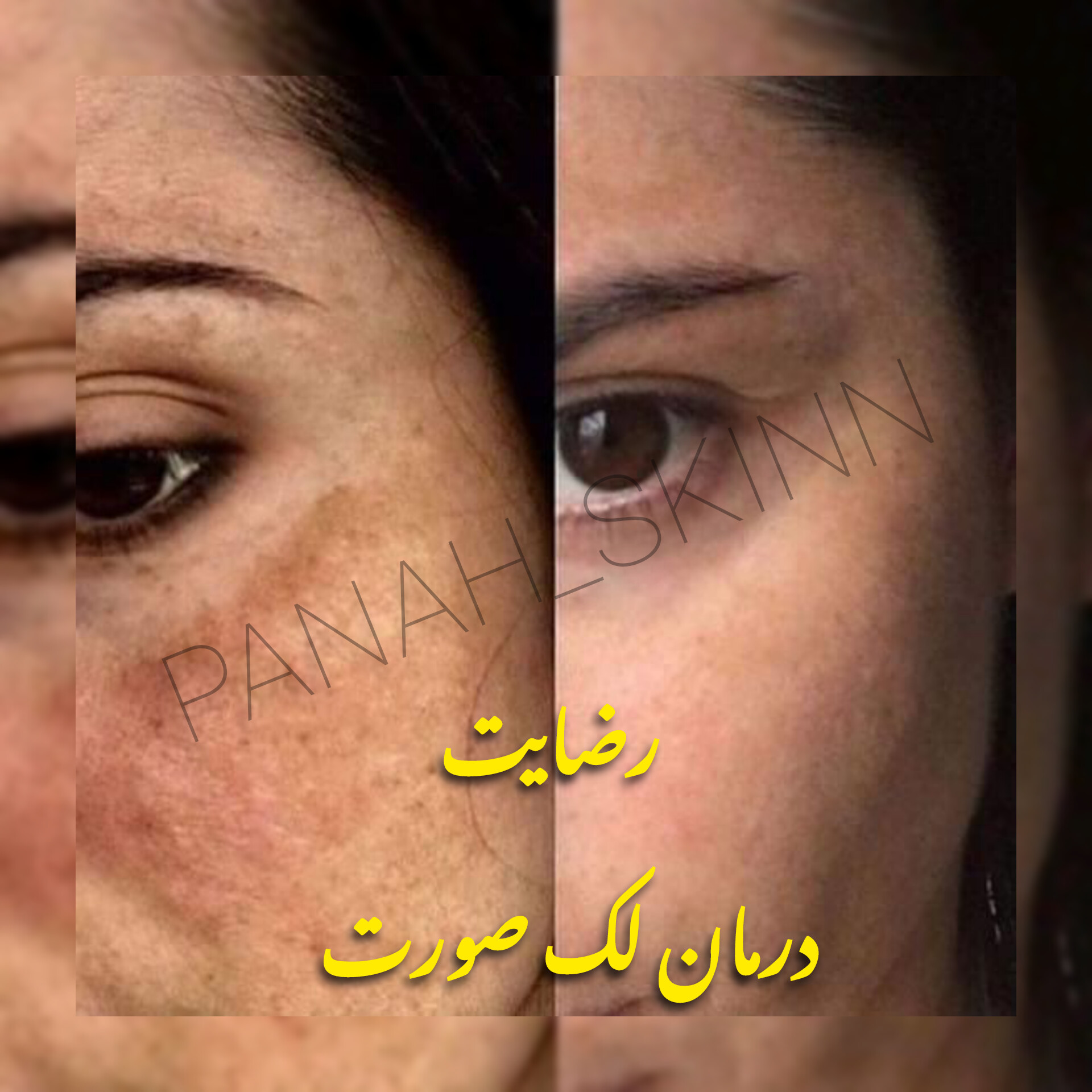 سرم ضدلک لاکچرکوین فرانسه 