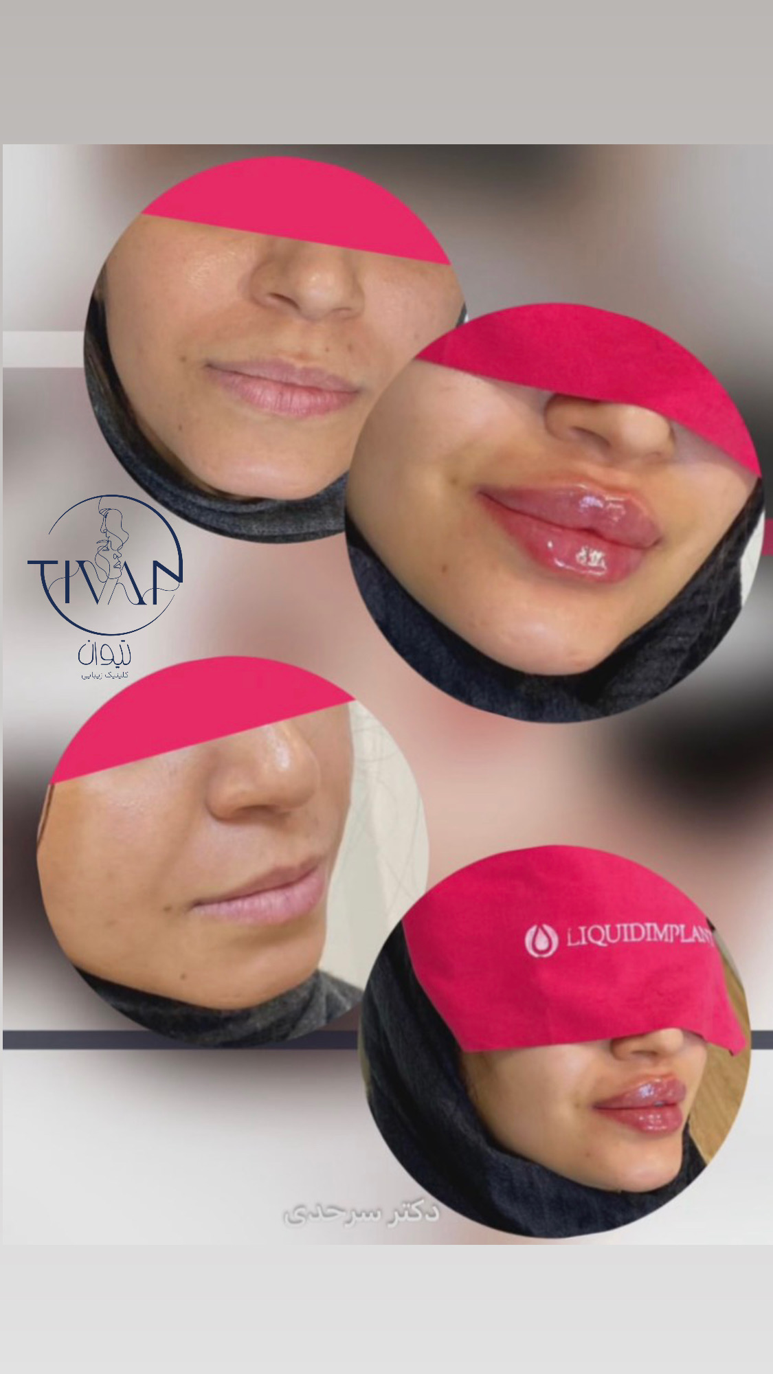 تزریقات زیبایی