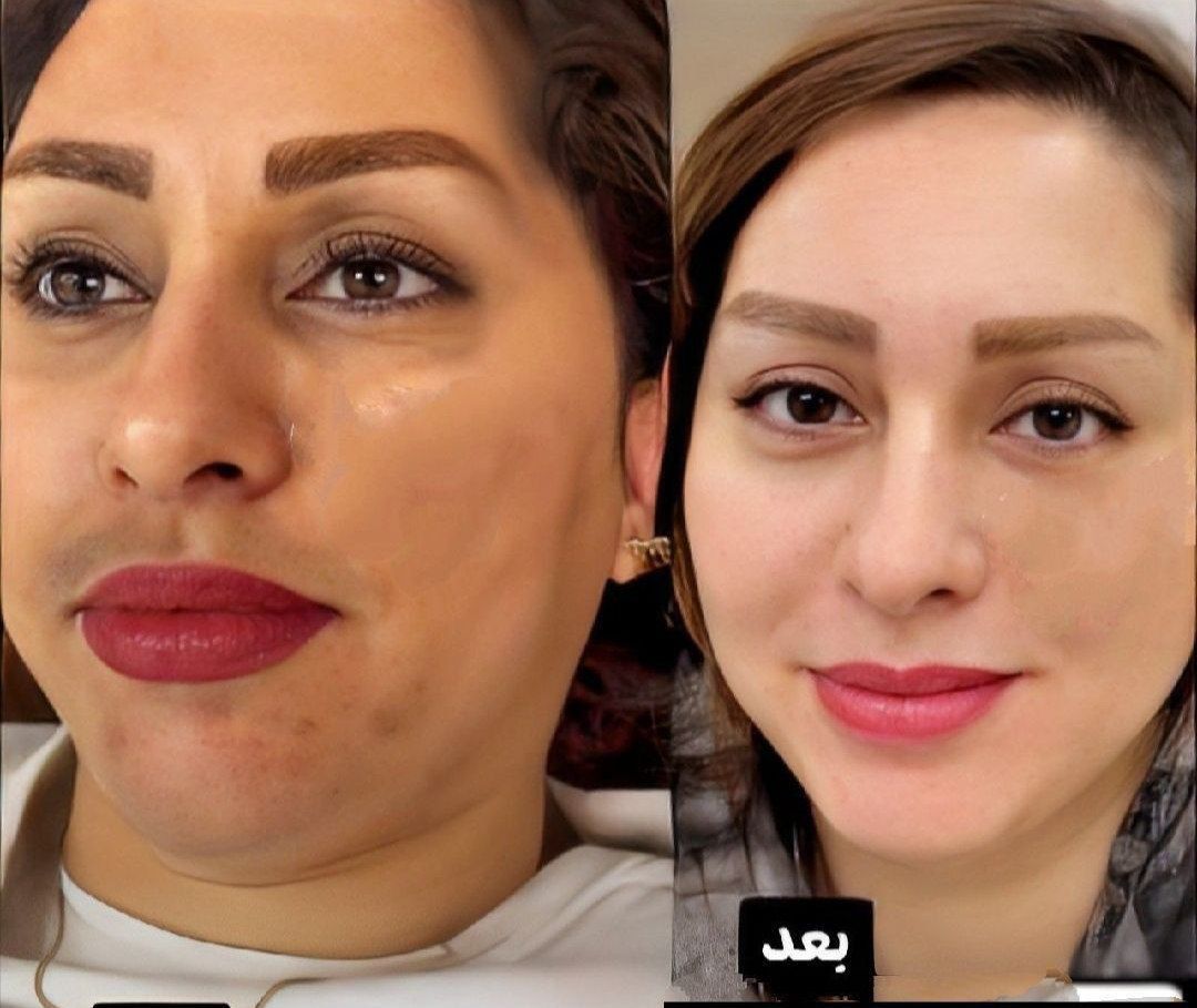 کرم ضدلک و سفید کننده 