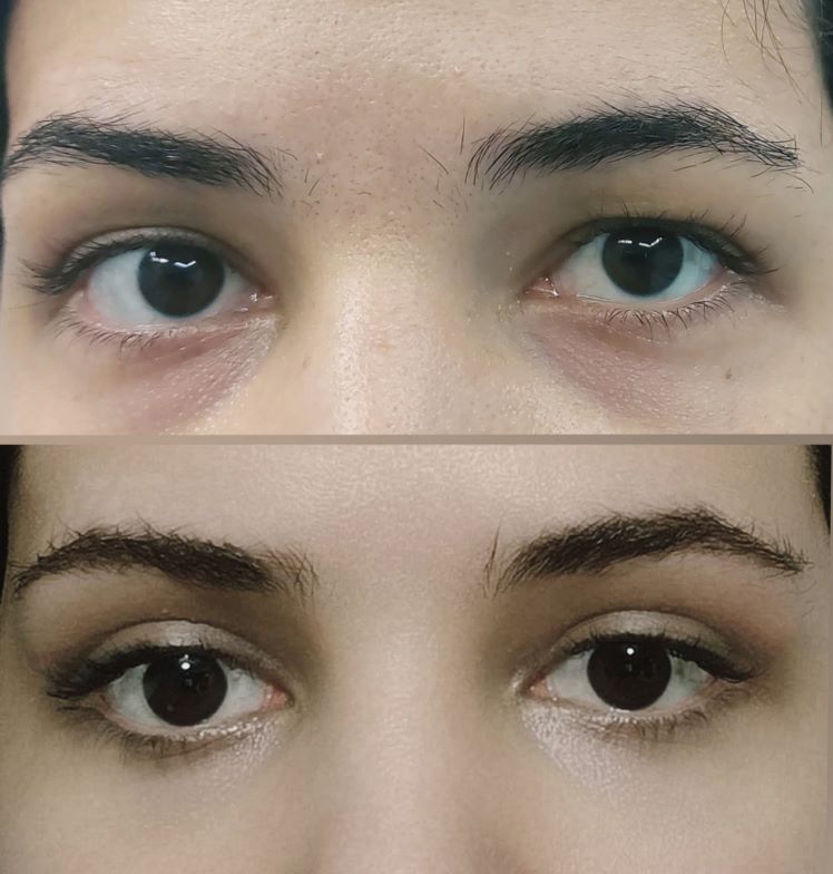 جراحی زیبایی پلک