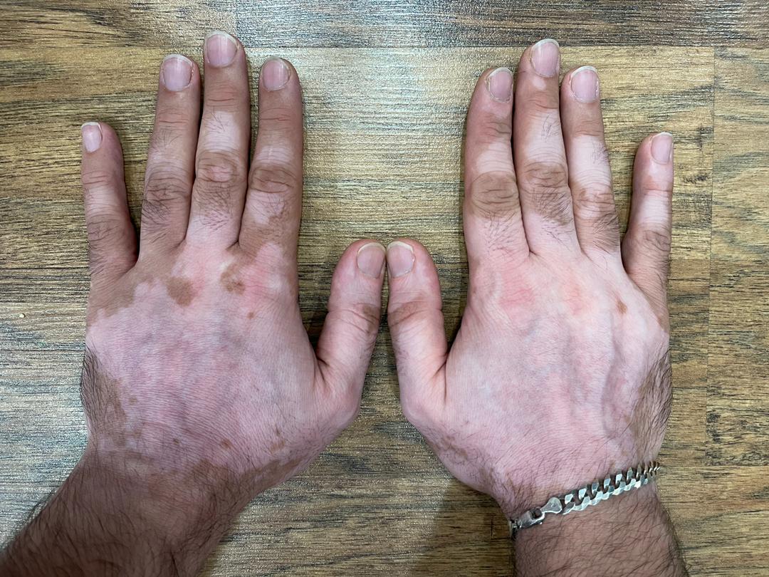 درمان پیسی و ویتیلیگو و برص