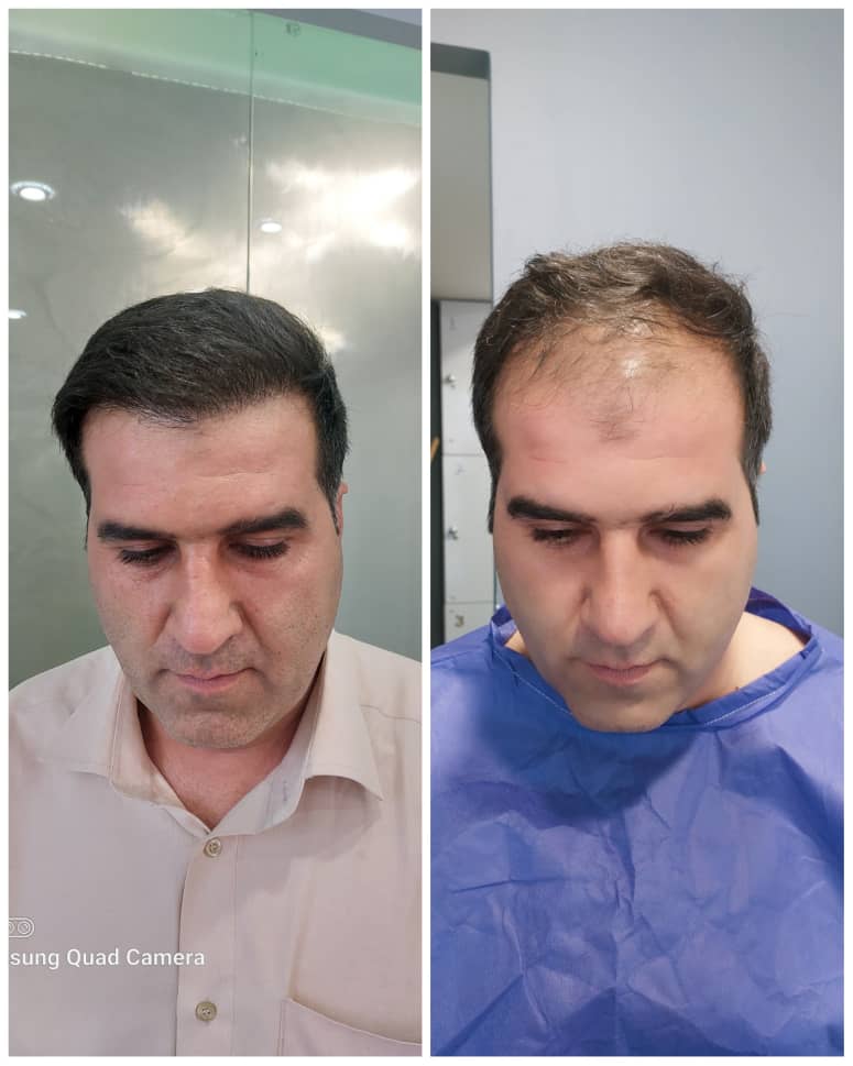 جشنواره کاشت مو ،ابرو ، ریش