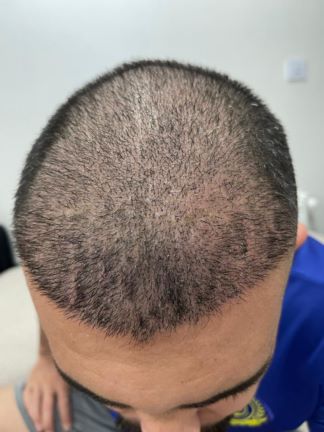 کاشت مو و ابرو در شیراز