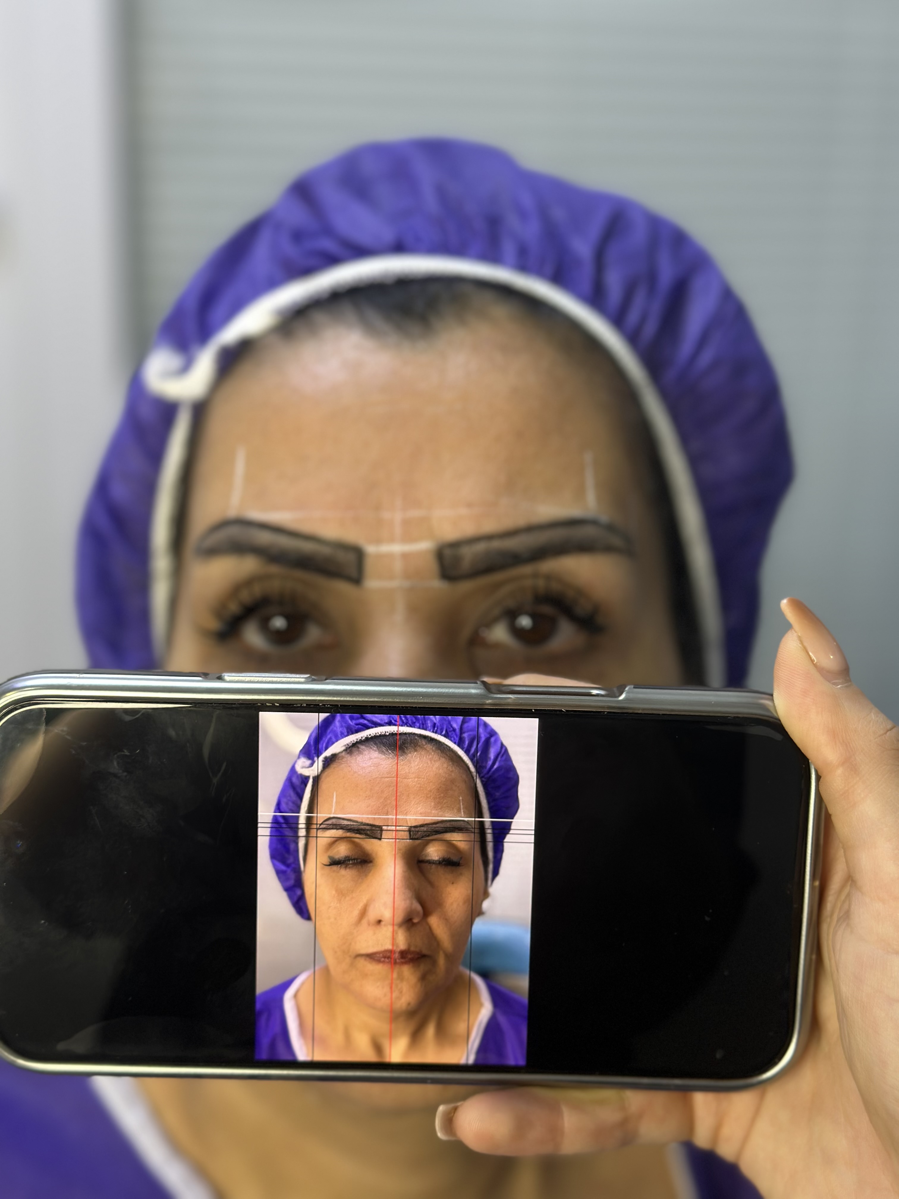 کاشت مو طبیعی 