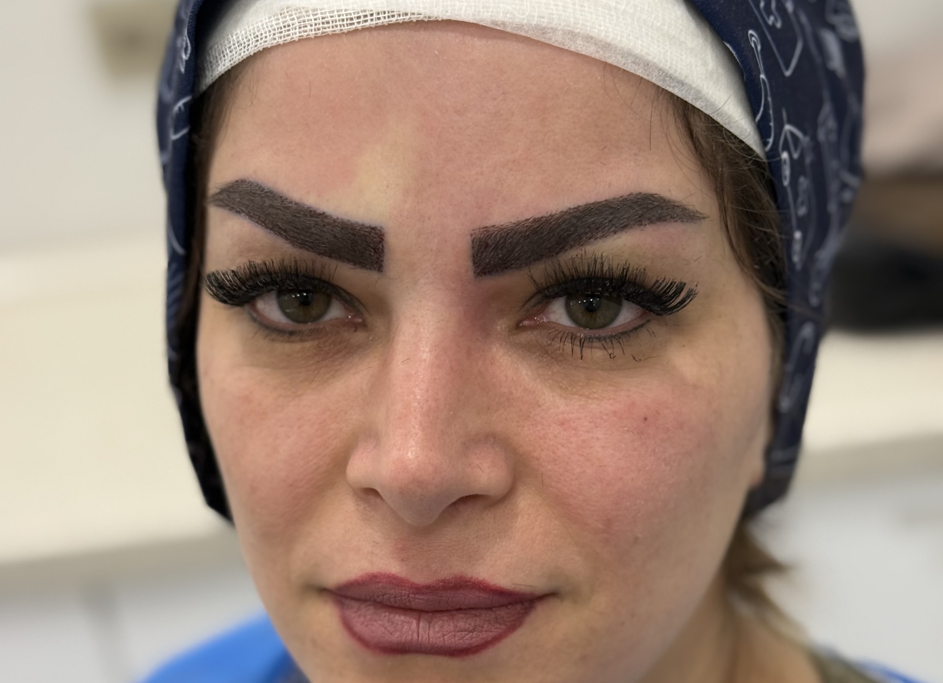 کاشت ابرو طبیعی پرتراکم