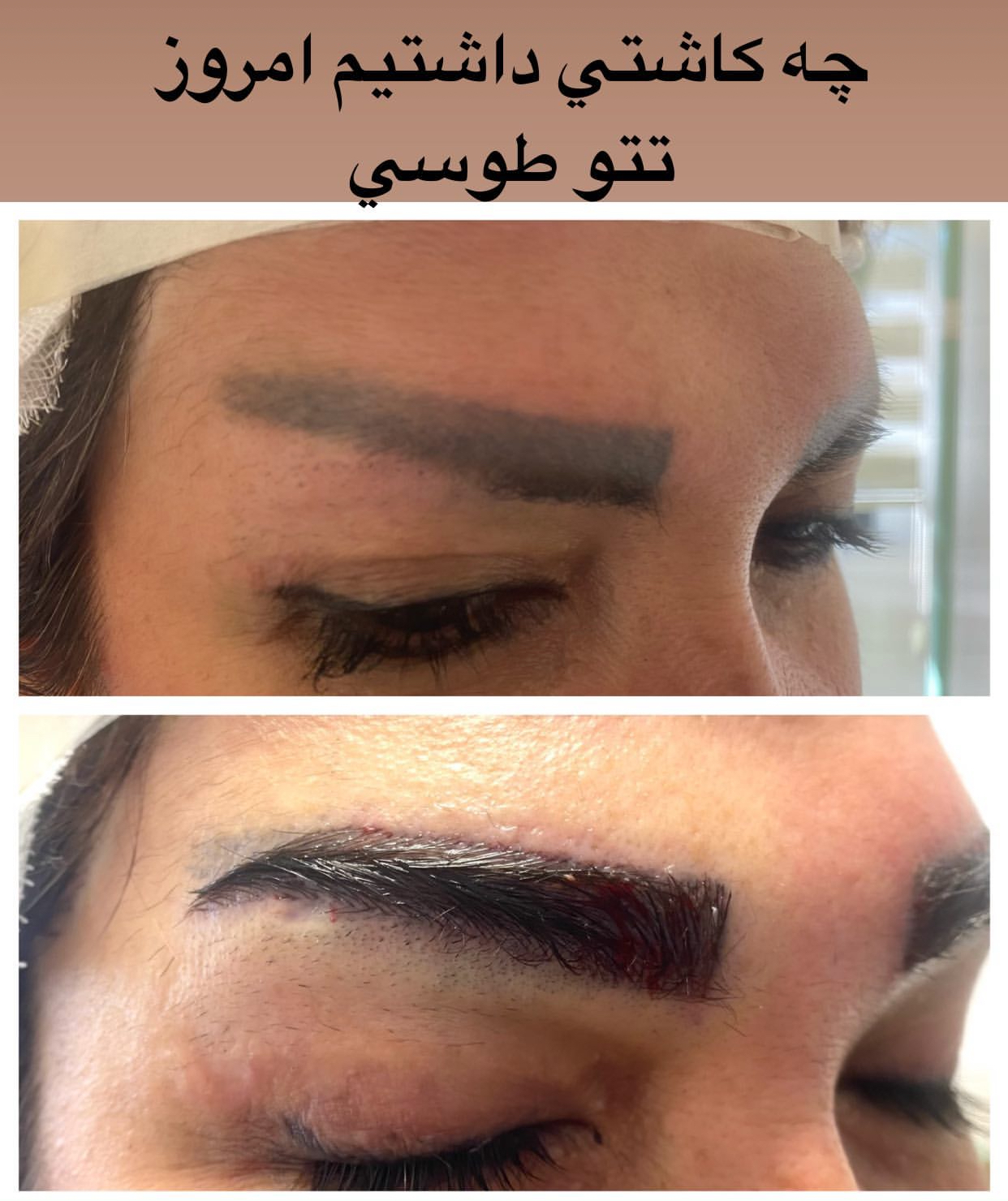 كاشت تخصصي ابرو و مو