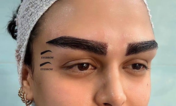 کاشت ابرو طبیعی پرتراکم