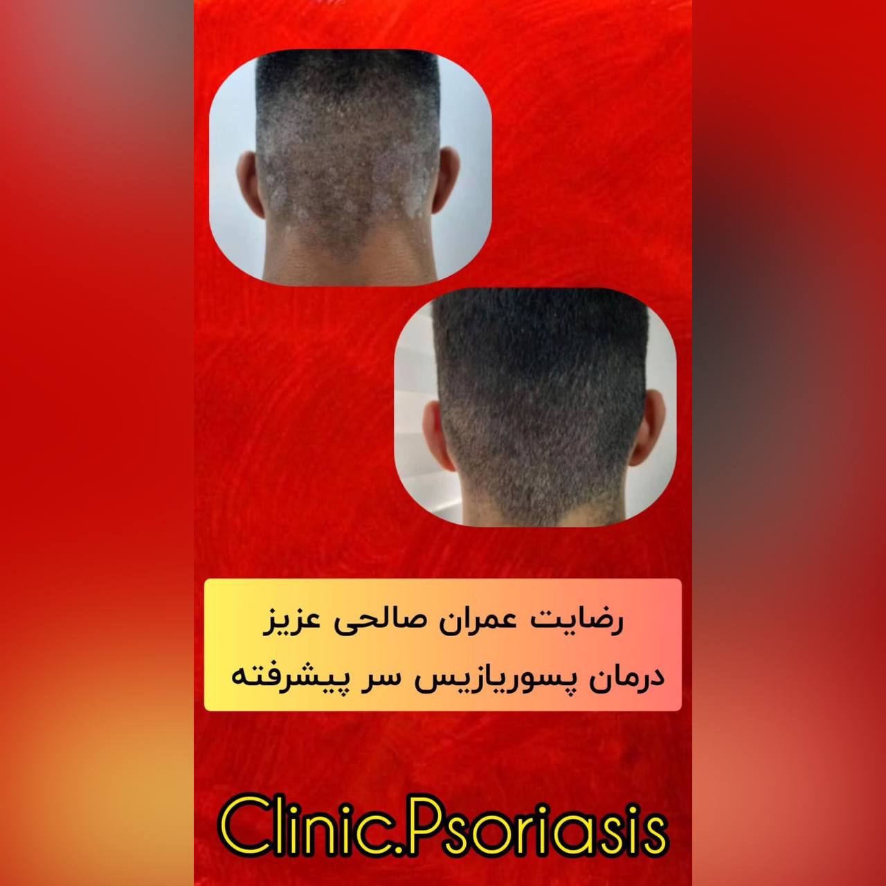 درمان پیسی و پسوریازیس