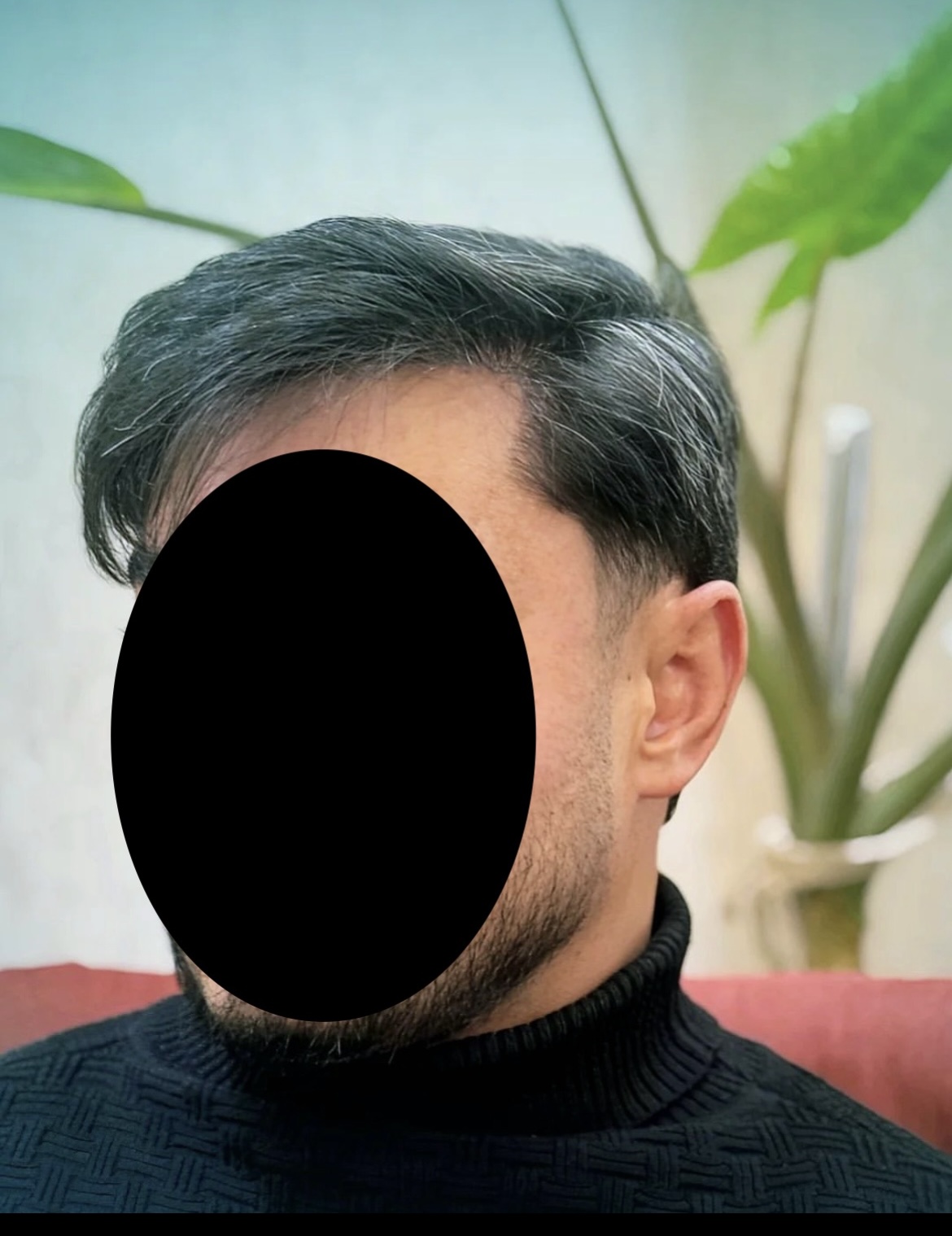 کاشت مو و ابرو توسط کادر درمان