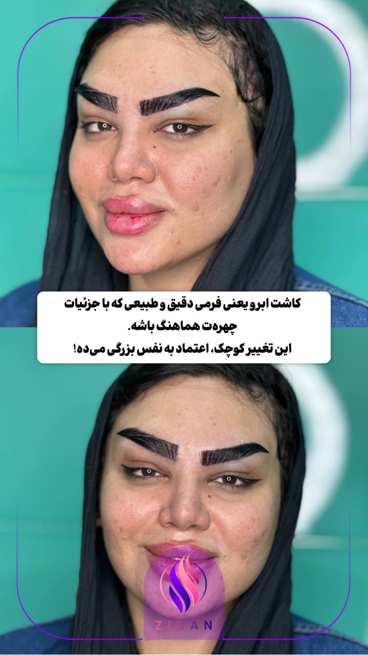 کاشت مو و کاشت ابرو 