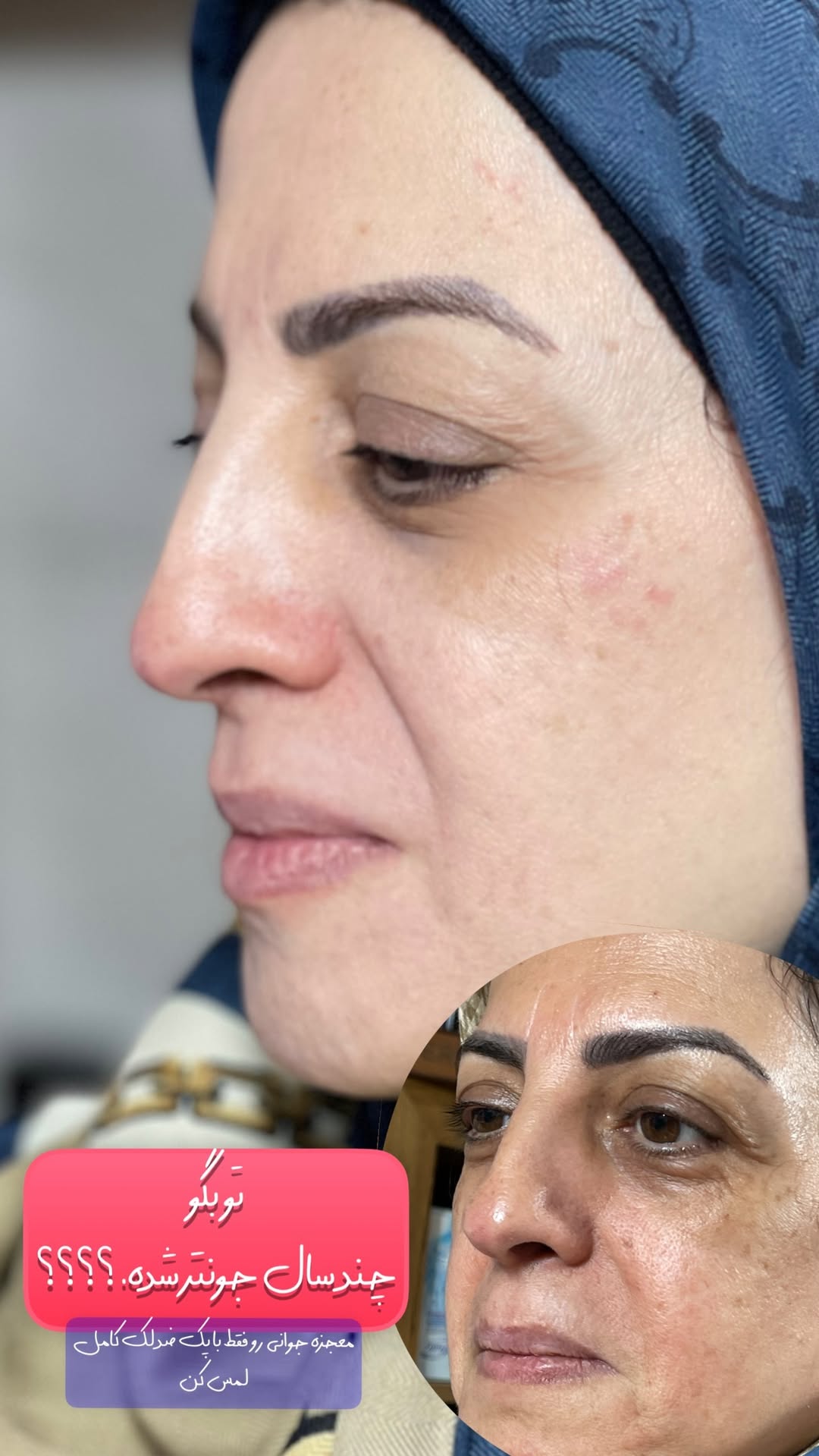 کرم ضدلک و سفید کننده 