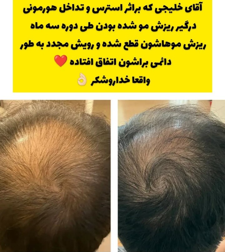 درمان قطعی انواع ریزش مو